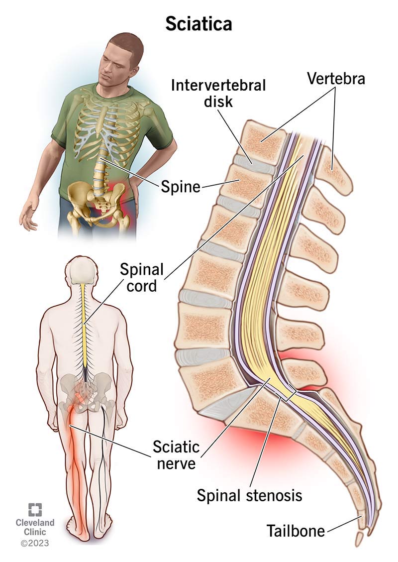 SCIATICA