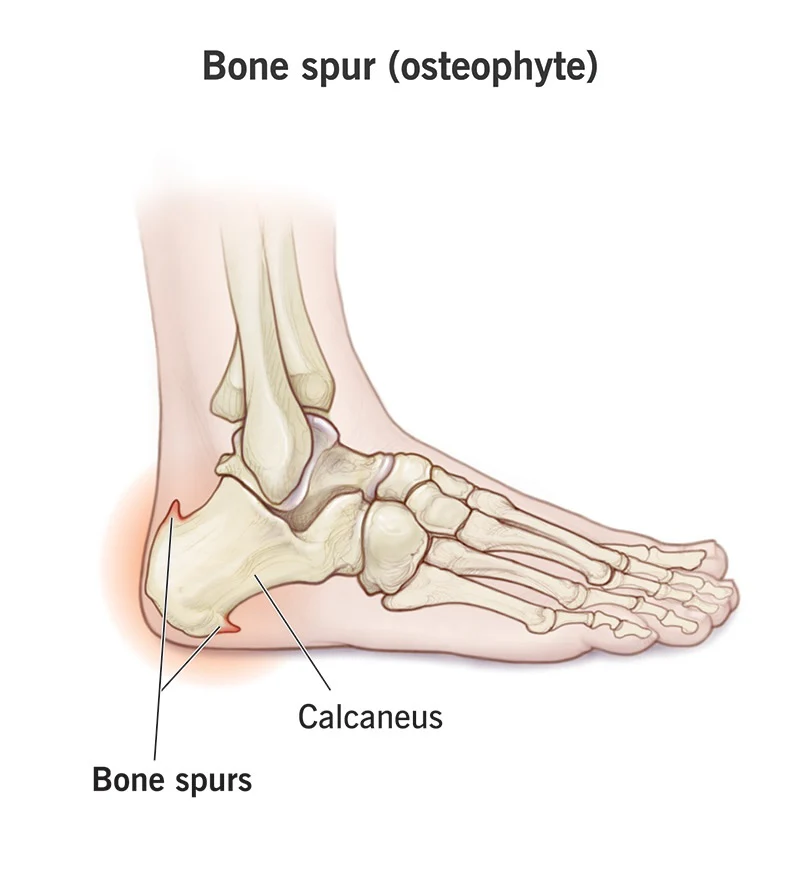 HEEL SPUR (calcaneal spur)