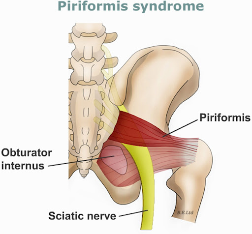 PIRIFORMIS SYNDROME