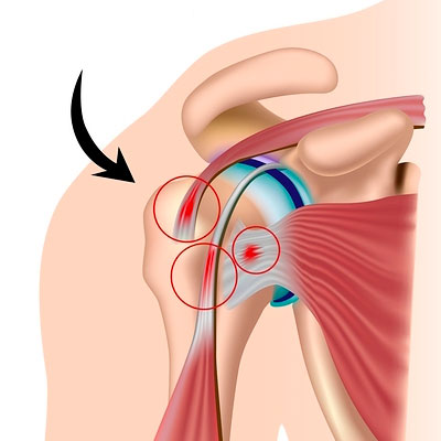 ROTATOR CUFF TENDINITIS